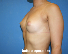 plastic-surgery-breast-augmentation